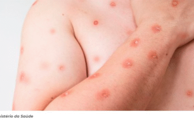 Brasil contabiliza 47 casos da MPOX, doença infecciosa